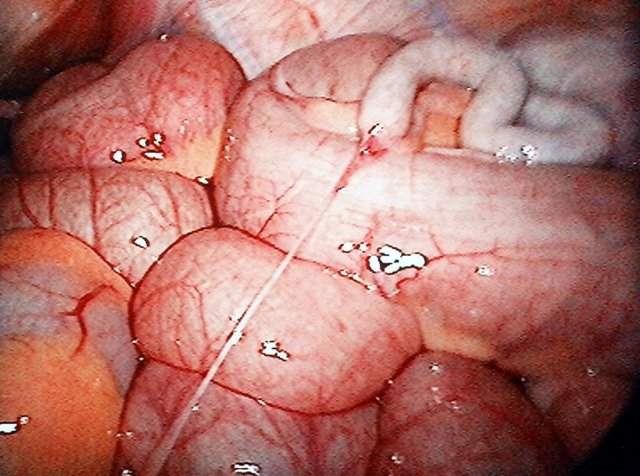 Vitals and Bits #3: The Appendix